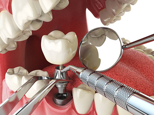 Best Emergency Broken Tooth Repair in Earlham, IA