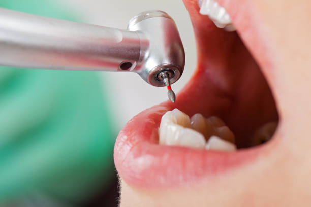 Best Emergency Tooth Extraction in Earlham, IA